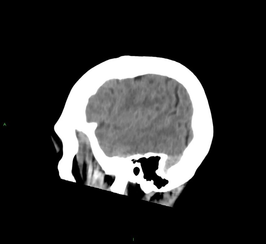 Cerebral amyloid angiopathy-associated lobar intracerebral hemorrhage (Radiopaedia 58752-65973 C 12).jpg