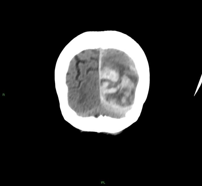 File:Cerebral amyloid angiopathy-associated lobar intracerebral hemorrhage (Radiopaedia 58754-65975 Coronal non-contrast 10).jpg