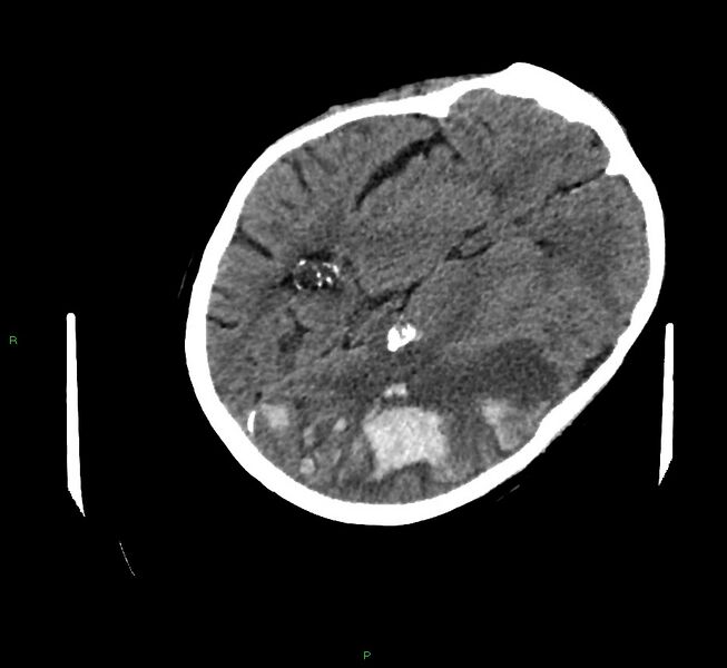 File:Cerebral amyloid angiopathy-associated lobar intracerebral hemorrhage (Radiopaedia 58757-65979 Axial non-contrast 59).jpg