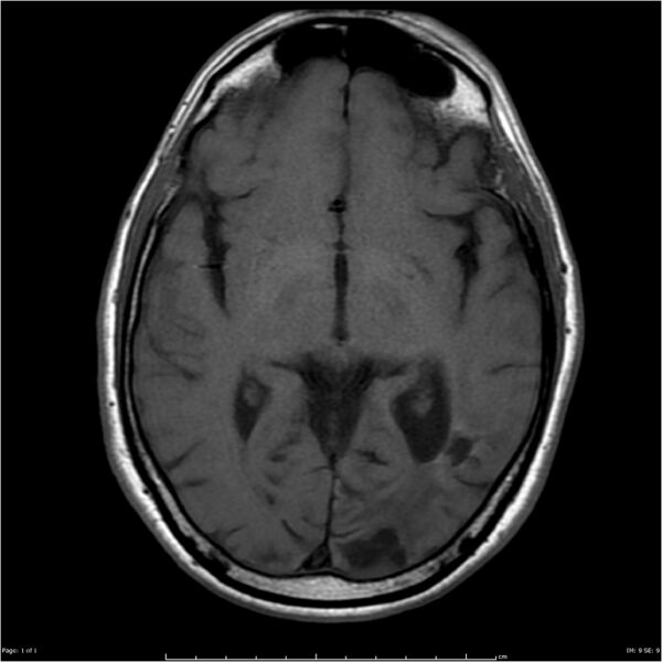 File:Cerebral amyloid angiopathy (Radiopaedia 4561-6683 Axial T1 1).jpg