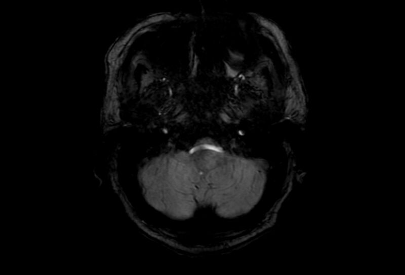 File:Cerebral amyloid angiopathy (Radiopaedia 86671-102792 Axial Gradient Echo 50).jpg