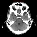 Cerebral and orbital tuberculomas (Radiopaedia 13308-13310 Axial non-contrast 9).jpg