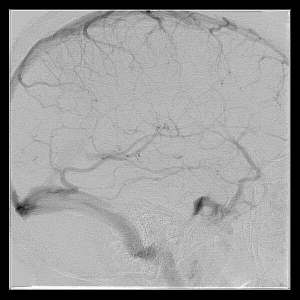 File:Cerebral aneurysm with rupture (Radiopaedia 29933-30458 LT CCA IC 48).jpg