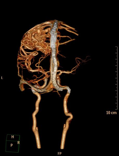 File:Cerebral arteriovenous malformation (Radiopaedia 29531-30031 B 11).jpg