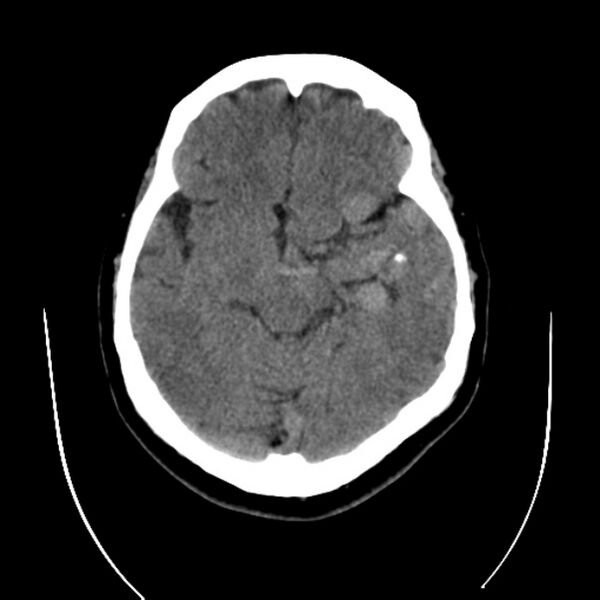 File:Cerebral arteriovenous malformation (Radiopaedia 43729-47189 Axial non-contrast 16).jpg