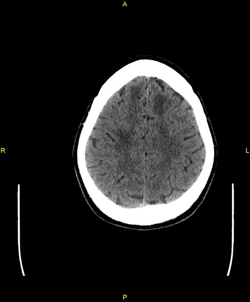 File:Cerebral autosomal dominant arteriopathy with subcortical infarcts and leukoencephalopathy (CADASIL) (Radiopaedia 86108-102051 Axial non-contrast 88).jpg