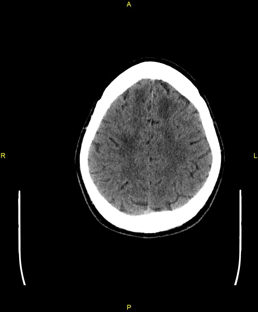 Cerebral autosomal dominant arteriopathy with subcortical infarcts and leukoencephalopathy (CADASIL) (Radiopaedia 86108-102051 Axial non-contrast 88).jpg