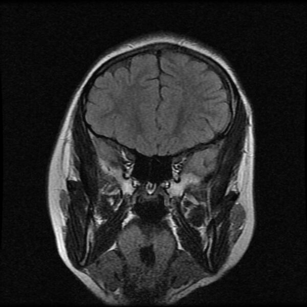 File:Cerebral cavernous malformation (Radiopaedia 44301-47942 Coronal FLAIR 2).jpg