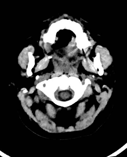File:Cerebral edema due to severe hyponatremia (Radiopaedia 89826-106938 Axial non-contrast 5).jpg