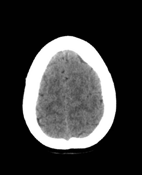 File:Cerebral edema due to severe hyponatremia (Radiopaedia 89826-106938 Axial non-contrast 87).jpg