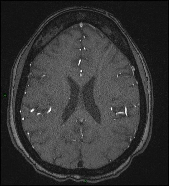 File:Cerebral fat embolism (Radiopaedia 35022-36525 Axial TOF 132).jpg
