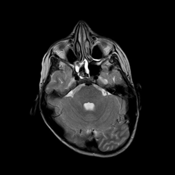 File:Cerebral tuberculoma (Radiopaedia 41152-43932 Axial T2 6).jpg
