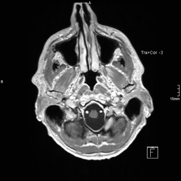 File:Cervical dural CSF leak on MRI and CT treated by blood patch (Radiopaedia 49748-54995 Axial T1 C+ 15).jpg