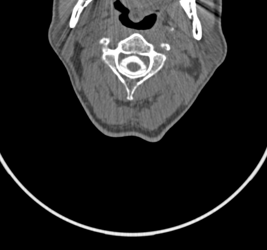 Cervical dural CSF leak on MRI and CT treated by blood patch (Radiopaedia 49748-54996 B 22).png