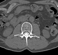 Cervical dural CSF leak on MRI and CT treated by blood patch (Radiopaedia 49748-54996 B 96).png