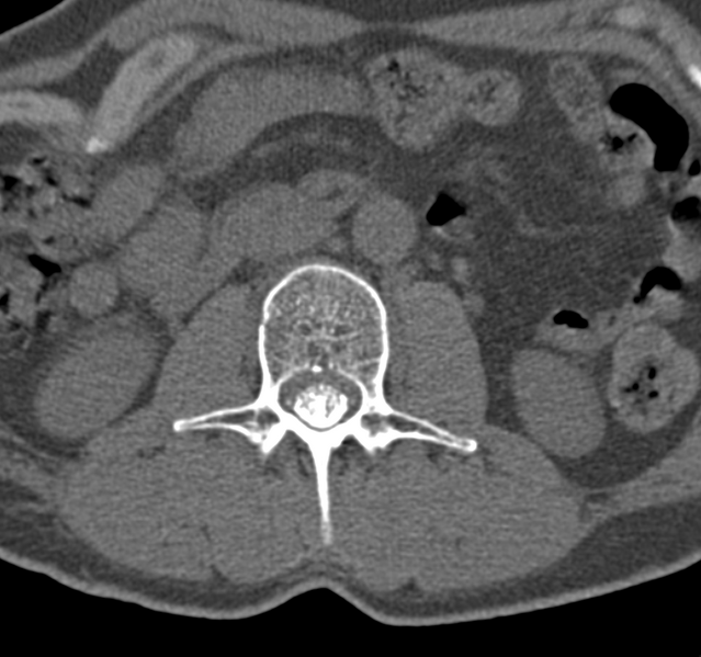 File:Cervical dural CSF leak on MRI and CT treated by blood patch (Radiopaedia 49748-54996 B 96).png