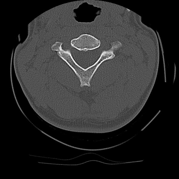 File:Cervical flexion teardrop fracture with cord hemorrhage (Radiopaedia 32497-33454 Axial bone window 27).jpg