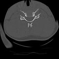 Cervical flexion teardrop fracture with cord hemorrhage (Radiopaedia 32497-33454 Axial bone window 56).jpg