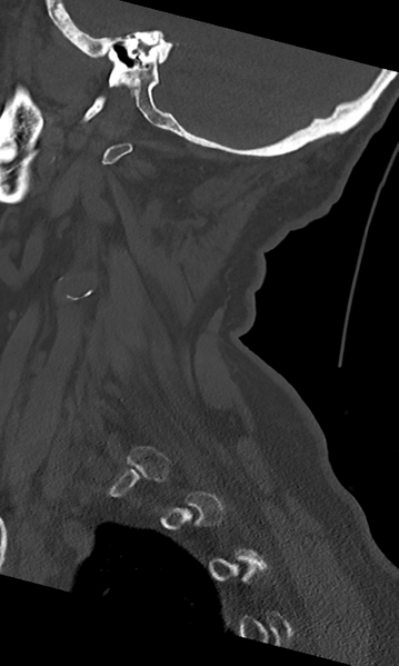 File:Cervical spine fracture - chalk stick (Radiopaedia 39116-41323 Sagittal bone window 13).png
