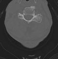 Cervical spondylolysis (Radiopaedia 49616-54811 Axial bone window 31).png