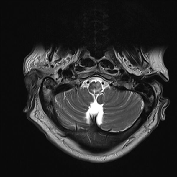 File:Cervical tumor-like myelopathy due to Type V dAVF (Radiopaedia 82461-96604 Axial T2 1).jpg