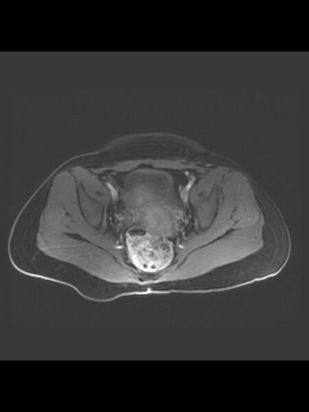 File:Cesarean section scar endometrioma (Radiopaedia 56569-63297 Axial T1 C+ fat sat 18).jpg