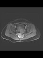 Cesarean section scar endometrioma (Radiopaedia 56569-63297 Axial T1 C+ fat sat 18).jpg