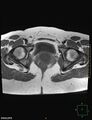 Cesarian scar endometriosis (Radiopaedia 68495-78066 Axial T1 20).jpg