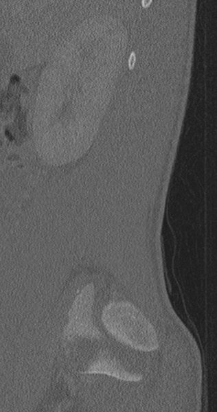 File:Chance fracture (Radiopaedia 40360-42912 Sagittal bone window 84).png