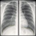 Chest x-ray - breathing (Radiopaedia 32556-33507 F 1).jpg