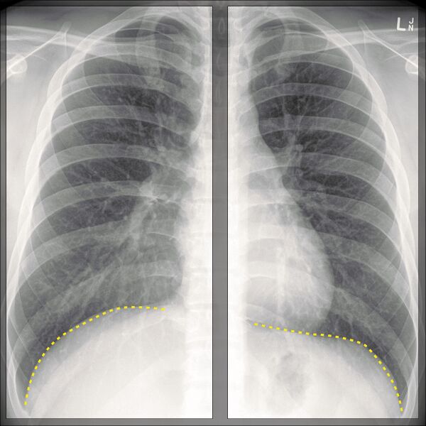 File:Chest x-ray - breathing (Radiopaedia 32556-33507 F 1).jpg