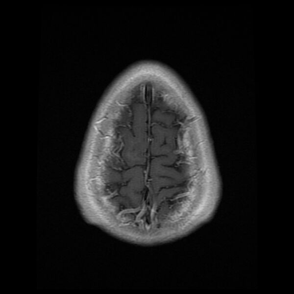 File:Chiasmatic-hypothalamic juvenile pilocytic astrocytoma (Radiopaedia 78533-91236 Axial T1 C+ 26).jpg
