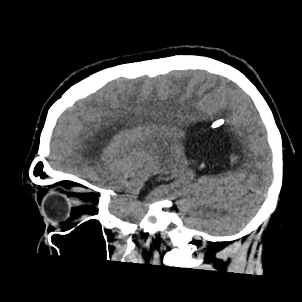 File:Chiasmatic-hypothalamic juvenile pilocytic astrocytoma (Radiopaedia 78533-91237 B 42).jpg