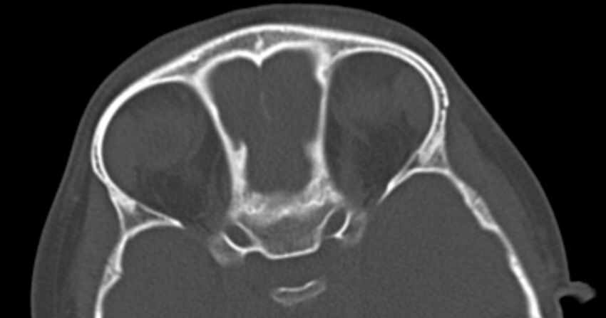 Choanal atresia (Radiopaedia 51295-56972 Axial bone window 56).jpg