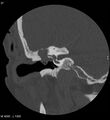Cholesteatoma (Radiopaedia 5467-7197 Coronal bone window 12).jpg