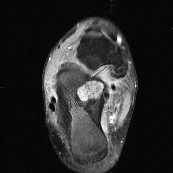 File:Chondroblastoma- calcaneum (Radiopaedia 10337-10859 Axial T2 fat sat 1).jpg