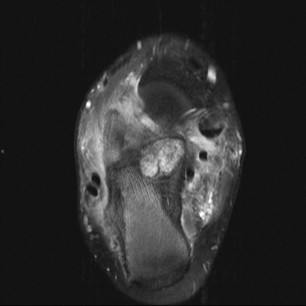 File:Chondroblastoma- calcaneum (Radiopaedia 10337-10859 B 2).jpg