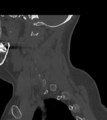 Chordoma (C4 vertebra) (Radiopaedia 47561-52188 Sagittal bone window 20).png