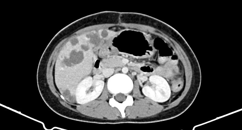 File:Choriocarcinoma liver metastases (Radiopaedia 74768-85766 A 94).jpg
