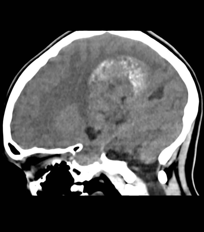 Choroid plexus carcinoma (Radiopaedia 91013-108552 B 44).jpg