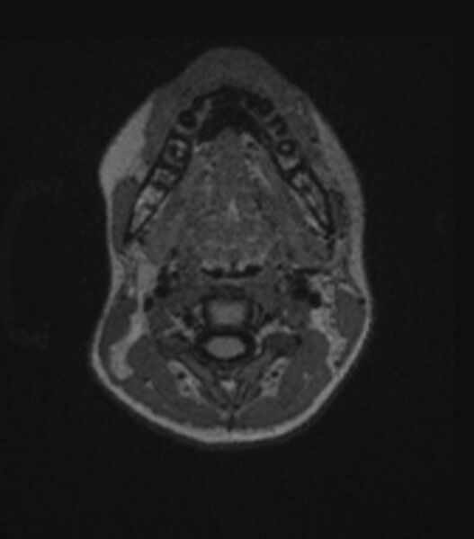 File:Choroid plexus carcinoma (Radiopaedia 91013-108553 Axial FLAIR C+ 31).jpg