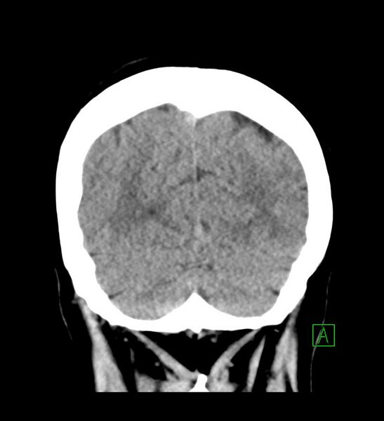 File:Choroid plexus xanthogranuloma (Radiopaedia 91271-108874 Coronal non-contrast 29).jpg