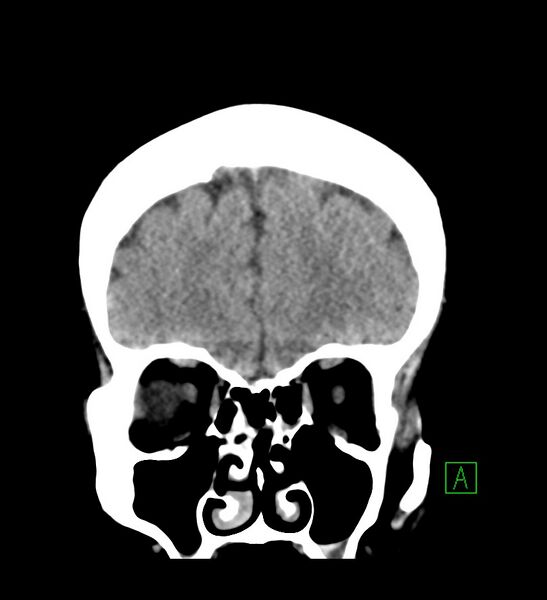 File:Choroid plexus xanthogranuloma (Radiopaedia 91271-108874 Coronal non-contrast 8).jpg