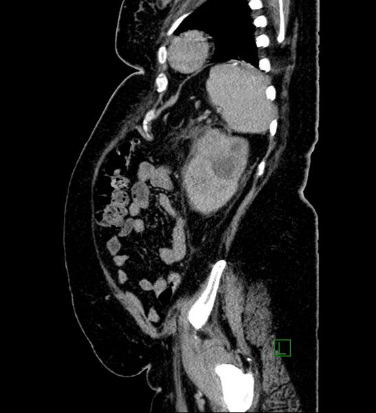 File:Chromophobe renal cell carcinoma (Radiopaedia 84239-99519 G 27).jpg