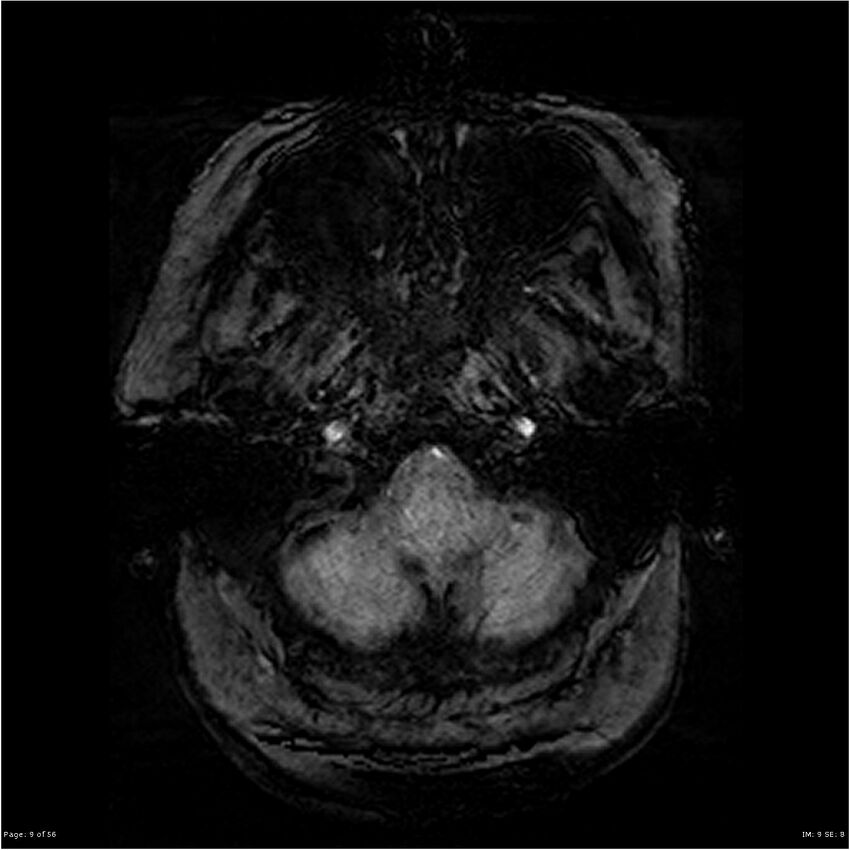 Chronic hypertensive encephalopathy (Radiopaedia 25764-25918 Axial SWI 9).jpg