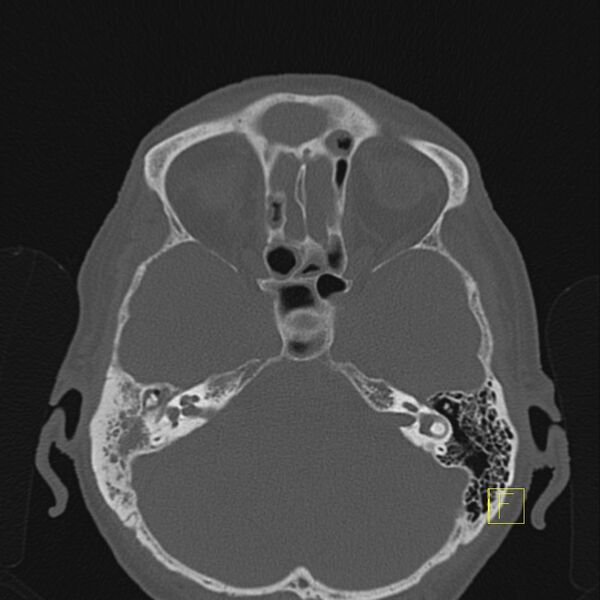 File:Chronic otitis media (Radiopaedia 14994-14912 Axial bone window 7).JPEG