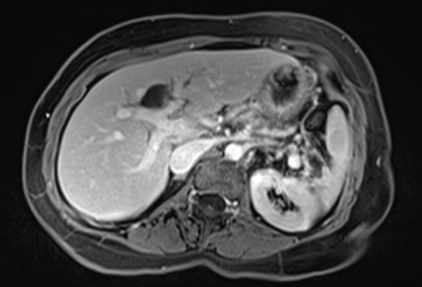 Chronic pancreatitis - pancreatic duct calculi (Radiopaedia 71818-82250 Axial T1 C+ fat sat 22).jpg