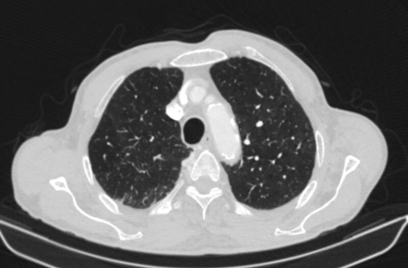 File:Chronic pulmonary embolism (Radiopaedia 91241-108843 Axial lung window 20).jpg