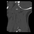 Clay-shoveler fracture (Radiopaedia 22568-22590 Sagittal bone window 46).jpg