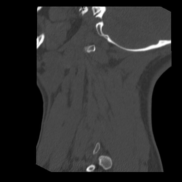File:Clay-shoveler fracture (Radiopaedia 22568-22590 Sagittal bone window 46).jpg